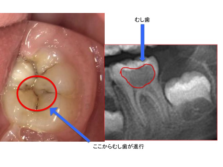 えっ！むし歯って年齢によってなりやすい部分が違うの？