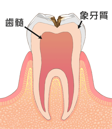 むし歯は年齢によってなりやすい部位が違うって知っていますか？