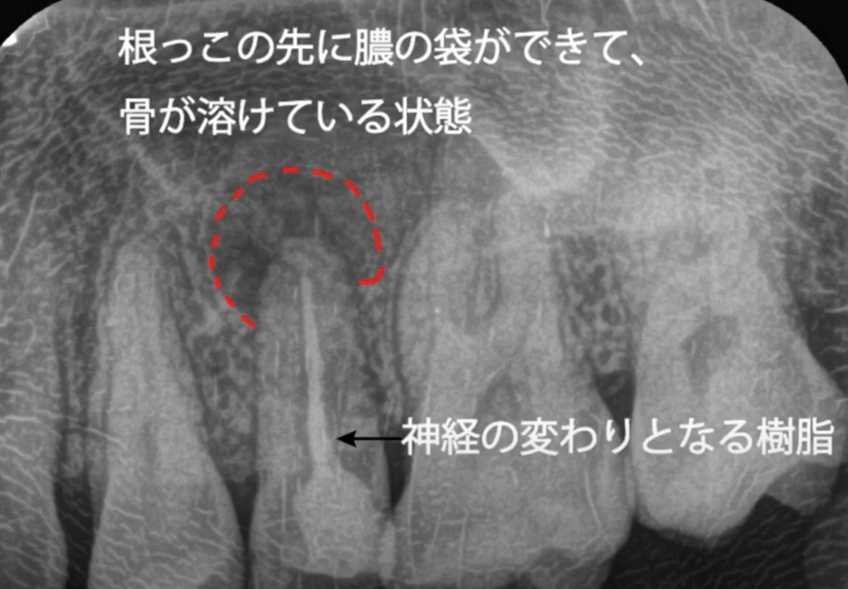 歯の根っこの治療について