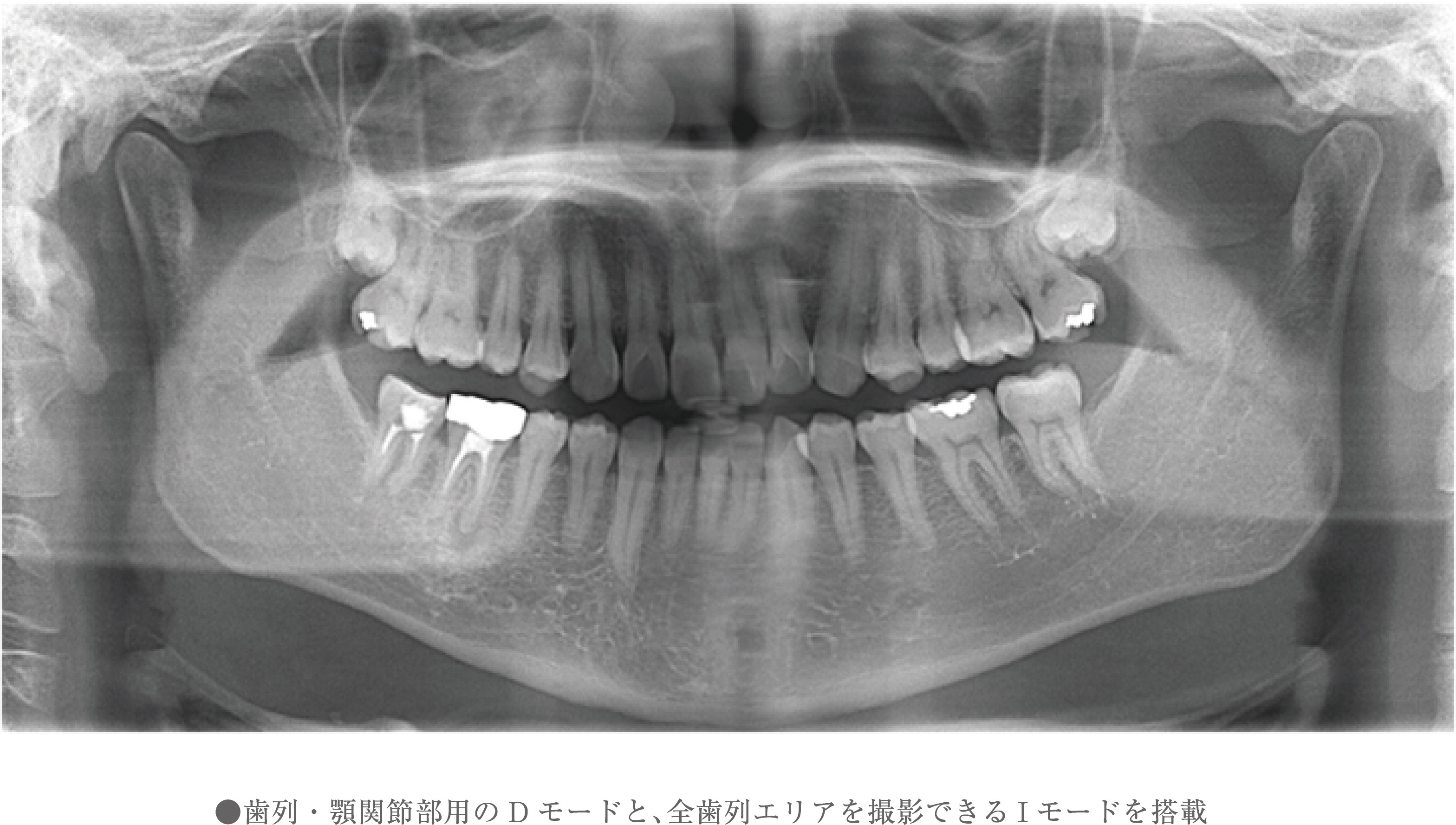 ●歯列・顎関節部用のDモードと、全歯列エリアを撮影できるIモードを搭載